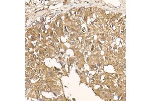 Immunohistochemistry of paraffin-embedded human breast cancer using [KO Validated]  Rabbit mAb (ABIN7271243) at dilution of 1:100 (40x lens). (AKT1 Antikörper)
