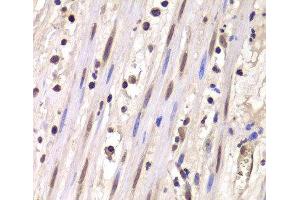 Immunohistochemistry of paraffin-embedded Human mammary cancer using LSM4 Polyclonal Antibody at dilution of 1:100 (40x lens). (LSM4 Antikörper)