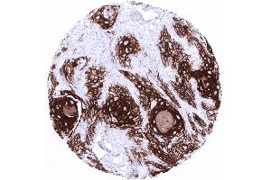 Strong Cytokeratin 10 immunostaining in a squamous cell carcinoma of the vulva. (Rekombinanter Keratin 10 Antikörper)