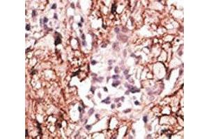 IHC analysis of FFPE human breast carcinoma tissue stained with the LSD1 antibody (LSD1 Antikörper  (AA 108-142))