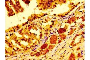 Immunohistochemistry of paraffin-embedded human prostate cancer using ABIN7147000 at dilution of 1:100 (Cathepsin D Antikörper  (AA 67-403))
