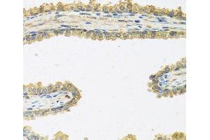 Immunohistochemistry of paraffin-embedded Human prostate using CRHBP Polyclonal Antibody at dilution of 1:100 (40x lens). (CRHBP Antikörper)