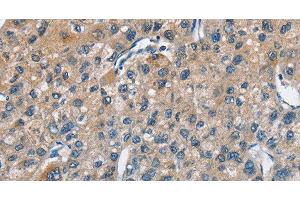 Immunohistochemistry of paraffin-embedded Human liver cancer using TRIP4 Polyclonal Antibody at dilution of 1:50 (TRIP4 Antikörper)