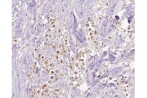 ABIN6266828 at 1/100 staining human Breast cancer tissue sections by IHC-P. (VPS72 Antikörper  (Internal Region))