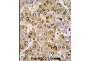 Formalin-fixed and paraffin-embedded human hepatocarcinoma tissue reacted with DDX5 antibody , which was peroxidase-conjugated to the secondary antibody, followed by DAB staining. (DDX5 Antikörper  (C-Term))