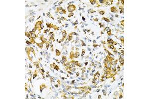 Immunohistochemistry of paraffin-embedded human gastric cancer using TAPBP Antibody (ABIN1875423) at dilution of 1:200 (40x lens). (TAPBP Antikörper)