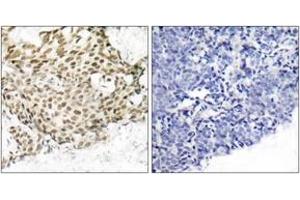 Immunohistochemistry analysis of paraffin-embedded human breast carcinoma tissue, using p95/NBS1 (Ab-343) Antibody. (Nibrin Antikörper  (AA 310-359))