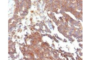 IHC testing of FFPE human ovarian carcinoma and GnRHR antibody (clone LCHR37) (GNRHR Antikörper)