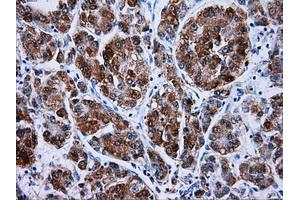 Immunohistochemical staining of paraffin-embedded Carcinoma of liver tissue using anti-HSD17B10mouse monoclonal antibody. (HSD17B10 Antikörper)
