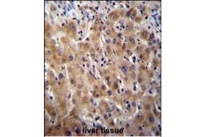 Glypican 3 (GPC3) Antibody (N-term) (ABIN390317 and ABIN2840749) immunohistochemistry analysis in formalin fixed and paraffin embedded human liver tissue followed by peroxidase conjugation of the secondary antibody and DAB staining. (Glypican 3 Antikörper  (N-Term))