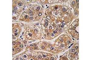 IHC analysis of FFPE human hepatocarcinoma tissue stained with AKR1A1 antibody (AKR1A1 Antikörper  (AA 293-325))