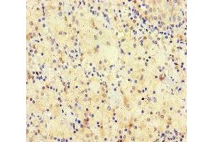 Immunohistochemistry of paraffin-embedded human lung cancer using ABIN7170512 at dilution of 1:100