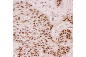 Anti-p63 Picoband antibody,  IHC(P): Human Oesophagus Squama Cancer Tissue (p63 Antikörper  (AA 311-680))