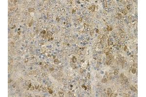 ABIN6259120 and ABIN6273365 at 1/100 staining human melanoma by IHC-P.