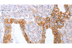 Immunohistochemistry of paraffin-embedded Human cervical cancer tissue using ABO Polyclonal Antibody at dilution 1:50 (ABO Antikörper)
