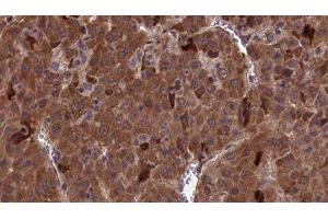 ABIN6277108 at 1/100 staining Human liver cancer tissue by IHC-P. (CD90 Antikörper  (Internal Region))