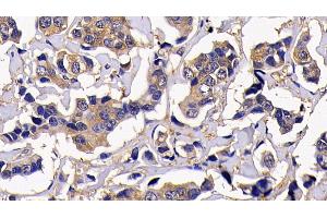 Detection of RIPK1 in Human Breast cancer Tissue using Polyclonal Antibody to Receptor Interacting Serine Threonine Kinase 1 (RIPK1) (RIPK1 Antikörper  (AA 17-289))
