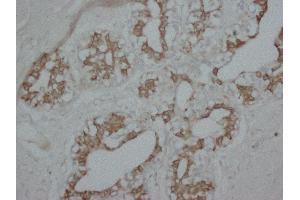 Anti-PKC alpha antibody, IHC(P) IHC(P): Human Mammary Cancer Tissue (PKC alpha Antikörper  (N-Term))