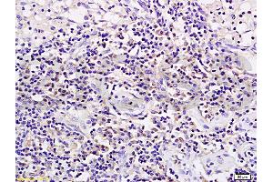 Formalin-fixed and paraffin embedded rat transplant lymphoma labeled with Anti-CD19 Polyclonal Antibody (ABIN724595), Unconjugated 1:200 followed by conjugation to the secondary antibody and DAB staining (CD19 Antikörper  (AA 485-556))