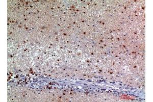 Immunohistochemistry (IHC) analysis of paraffin-embedded Human Kidney Cancer, antibody was diluted at 1:200. (SNCA Antikörper)