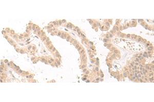 Immunohistochemistry of paraffin-embedded Human thyroid cancer tissue using PBXIP1 Polyclonal Antibody at dilution of 1:40(x200) (PBXIP1 Antikörper)