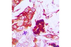 Immunohistochemical analysis of Aquaporin 3 staining in human lung cancer formalin fixed paraffin embedded tissue section.
