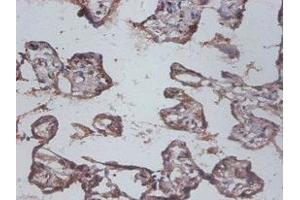 Immunohistochemistry of paraffin-embedded human colon cancer using ABIN7156785 at dilution of 1:100 (IL12B Antikörper  (AA 23-328))