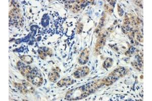 IHC testing of FFPE human breast cancerwith ROR1 antibody at 5ug/ml. (ROR1 Antikörper)