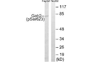 Immunohistochemistry analysis of paraffin-embedded human breast carcinoma tissue using Gab2 (Phospho-Ser623) antibody. (GAB2 Antikörper  (pSer623))