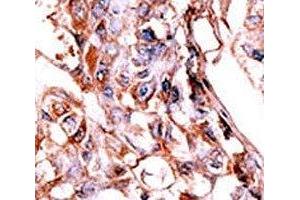 IHC analysis of FFPE human hepatocarcinoma tissue stained with the phospho-HER4 antibody. (ERBB4 Antikörper  (pTyr1188))