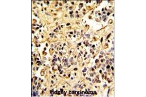 Formalin-fixed and paraffin-embedded human kidney carcinoma with Neprilysin Antibody (C-term), which was peroxidase-conjugated to the secondary antibody, followed by DAB staining. (MME Antikörper  (C-Term))
