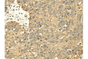 The image on the left is immunohistochemistry of paraffin-embedded Human breast cancer tissue using ABIN7128021(SRPRB Antibody) at dilution 1/30, on the right is treated with fusion protein.