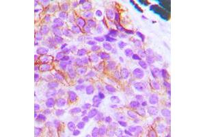 Immunohistochemical analysis of BIM staining in human breast cancer formalin fixed paraffin embedded tissue section. (BIM Antikörper  (N-Term))