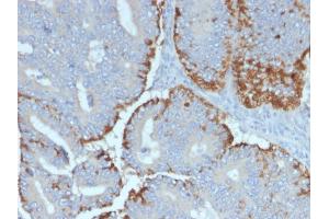 Formalin-fixed, paraffin-embedded human Colon Carcinoma stained with ATG5 Mouse Monoclonal Antibody (ATG5/2492). (ATG5 Antikörper  (AA 1-119))