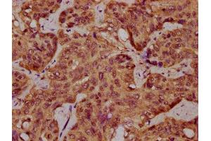 IHC image of ABIN7168937 diluted at 1:400 and staining in paraffin-embedded human liver cancer performed on a Leica BondTM system. (SPINK9 Antikörper  (AA 20-86))