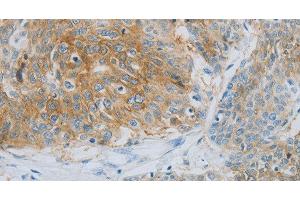 Immunohistochemistry of paraffin-embedded Human esophagus cancer using NDRG1 Polyclonal Antibody at dilution of 1:70 (NDRG1 Antikörper)