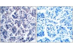 Immunohistochemistry analysis of paraffin-embedded human breast carcinoma tissue, using TYK2 (Ab-1054) Antibody. (TYK2 Antikörper  (AA 1020-1069))