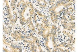 ABIN6258794 and ABIN6275896 at 1/100 staining Human colorectal cancer by IHC-P. (FAM3D Antikörper  (C-Term))