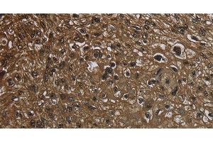 Immunohistochemistry of paraffin-embedded Human esophagus cancer using GLO1 Polyclonal Antibody at dilution of 1:50 (GLO1 Antikörper)