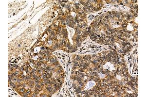 ABIN7095558 and ABIN7099615 at 1/100 staining human lung cancer by IHC-P.