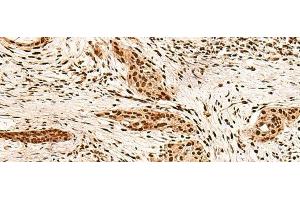 Immunohistochemistry of paraffin-embedded Human esophagus cancer tissue using PAFAH1B2 Polyclonal Antibody at dilution of 1:60(x200) (PAFAH1B2 Antikörper)