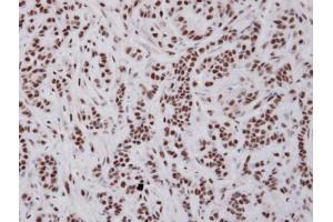IHC-P Image Immunohistochemical analysis of paraffin-embedded A549 xenograft , using UAP56, antibody at 1:100 dilution. (DDX39B Antikörper)