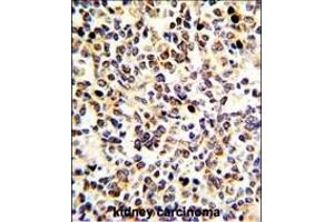 Formalin-fixed and paraffin-embedded human kidney carcinoma with KRT10 Antibody (N-term), which was peroxidase-conjugated to the secondary antibody, followed by DAB staining.