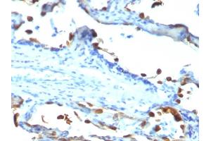 Formalin-fixed, paraffin-embedded human Lung Carcinoma stained with Milk Fat Globule Monoclonal Antibody (EDM45) (MFGE8 Antikörper)