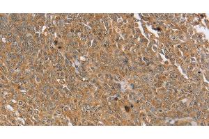 Immunohistochemistry of paraffin-embedded Human cervical cancer using PTPN20 Polyclonal Antibody at dilution of 1:30 (PTPN20 Antikörper)