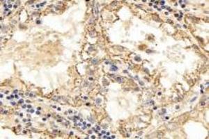 Immunohistochemistry analysis of paraffin-embedded human kidney cancer using TPPP3 (ABIN7076047) at dilution of 1: 3000 (TPPP3 Antikörper)