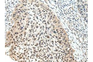 The image on the left is immunohistochemistry of paraffin-embedded Human esophagus cancer tissue using ABIN7191723(NSD1 Antibody) at dilution 1/25, on the right is treated with synthetic peptide.