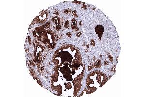 Prostate Adenocarcinoma Gleason 336 with strong PSA immunostaining of all tumor cells (Rekombinanter Prostate Specific Antigen Antikörper  (AA 150-250))