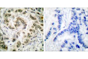 Peptide - +Immunohistochemical analysis of paraffin-embedded human lung carcinoma tissue usingantibody (#C0178). (E2F4 Antikörper)