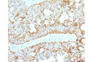 IHC testing of FFPE human colon carcinoma with MAML2 antibody (clone MMLP2-1). (MAML2 Antikörper)